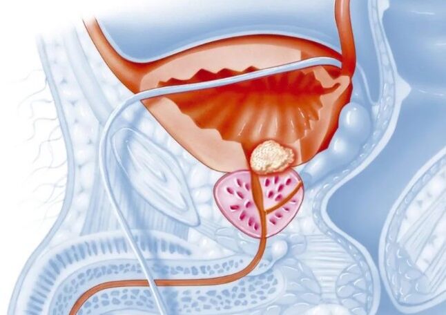 Caratteristiche della forma cronica di prostatite