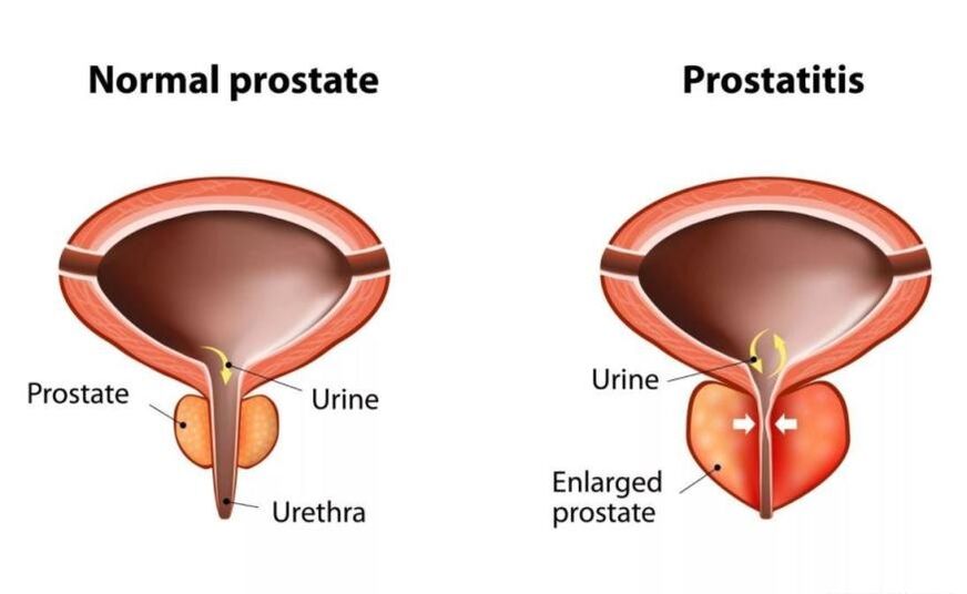 Prostata normale e infiammato