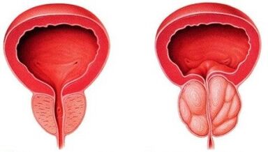 Prostata sana e infiammata con prostatite