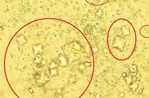 Ecco come appaiono al microscopio i cristalli di sale contenuti nelle urine con prostatite calcolosa