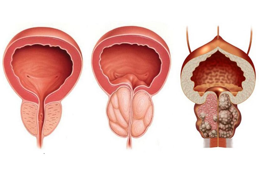 fasi della prostatite e necessità di trattamento con Prostavit